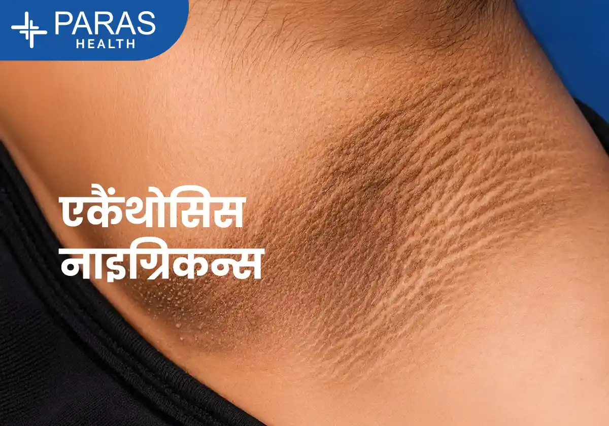एंकैंथोसिस निग्रिकंस